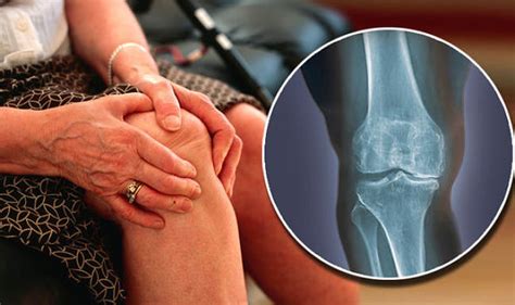 causas de la artrosis de rodilla y cómo aliviarla