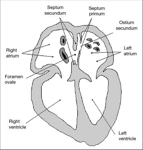 The Adult Heart With A Patent Foramen Ovale In Cross Sectional Plane