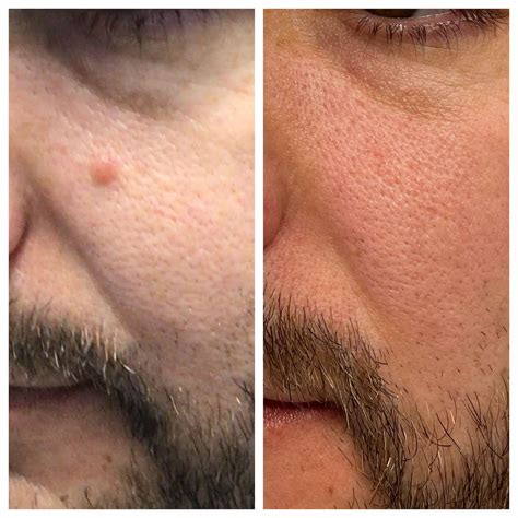 Mole Removal Before And After St Louis Dermatology And Cosmetic Surgery