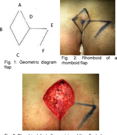 Figure 1 From Rhomboid Excision With Limberg Transposition Flap In The
