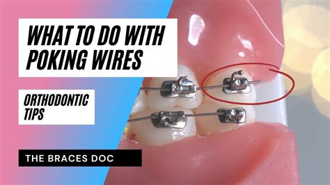 What To Do With Braces Poking Wire Braces Emergency Braces Tips