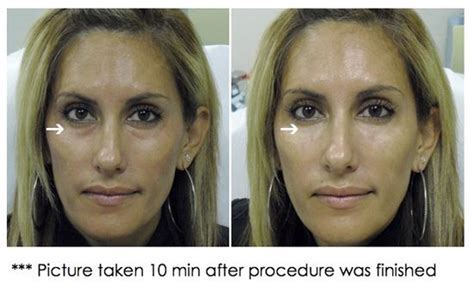 It takes 10 to 15 years to make a new vaccine. Using restylane/juvederm to fill the hollows under the eye ...