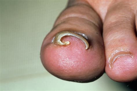 Ingrown Toenail Nhs