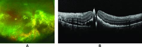 Ultra Widefield Fundus Image A And Oct Image B Of The Right Eye Of