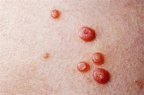 A Visual Guide To Viral Rashes Viral Rash Skin Bumps Wart Treatment