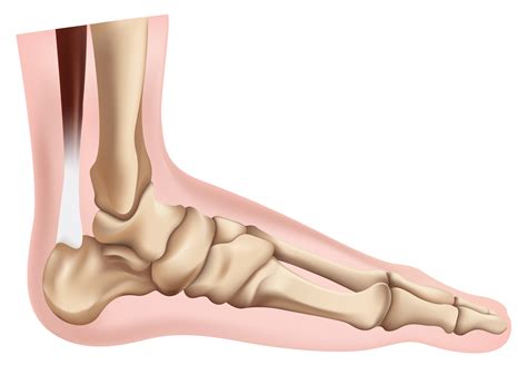 Total Ankle Replacement Direct Orthopedic Care