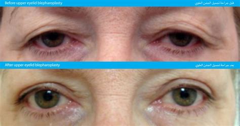 Cosmetic Eyelid Surgery Moorfields Eye Hospital Dubai Eye