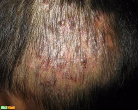 Cure Hair Loss Due To An Inflamed Scalp Visihow