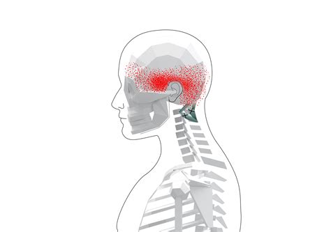 Suboccipital Muscles Trigger Points