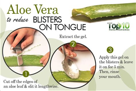 Home Remedies For Blisters On Tongue Top 10 Home Remedies