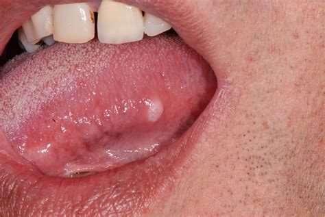 Tongue Cancer Tumor Symptoms Causes Diagnosis And Treatment In The Best Clinics