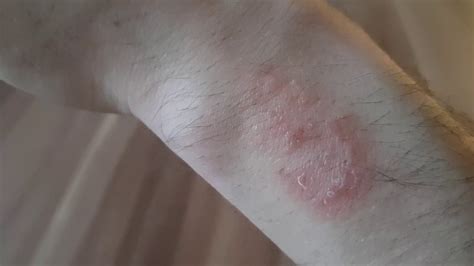 Garmin Instinct Review Skin Burn Skin Irritation Youtube