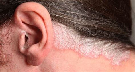 Psoriasis Una Enfermedad Que Afecta Al 2 De La Población Fundación