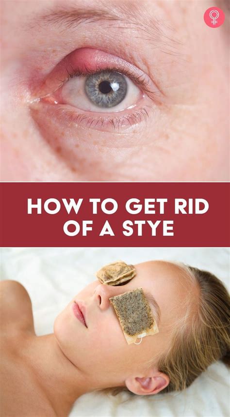 Eye Stye Remedies Artofit