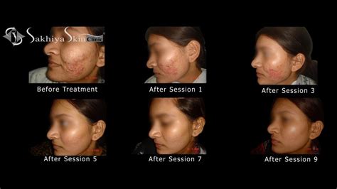 Pimple Treatments Best Result At Sakhiya Skin Clinic Youtube