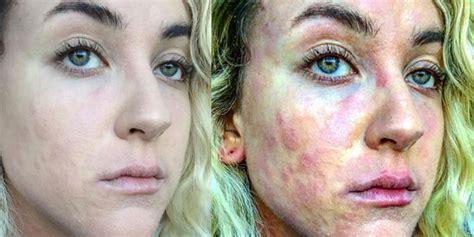 These Before And After Photos Show What It S Like To Live With Psoriasis SELF