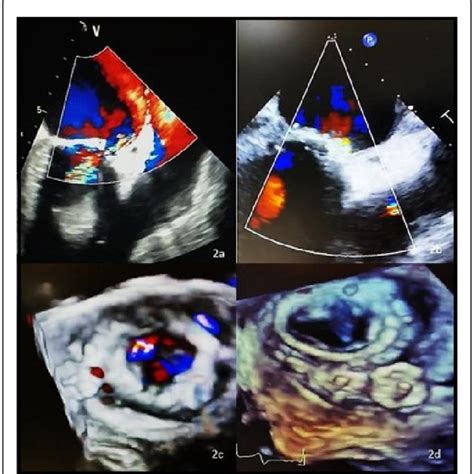 After Transcatheter Repair Of Paravalvular Leaks A Transesophageal