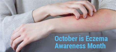Eczema Awareness Month Know The Symptoms And Book Your Appointment At