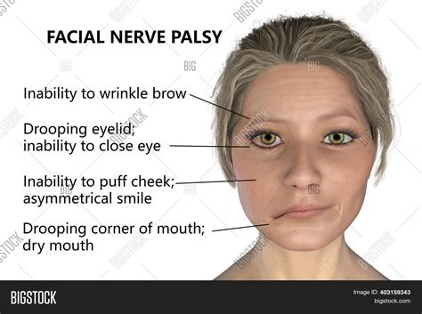 Facial Nerve Paralysis Image And Photo Free Trial Bigstock