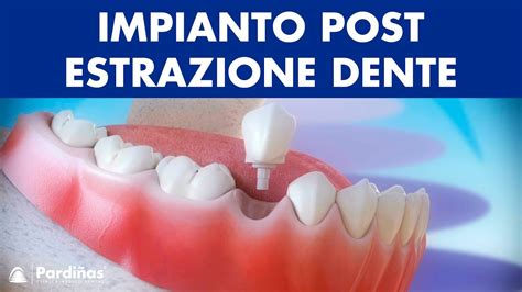 Impianto Dentale Immediato Post Estrazione Dente © Youtube