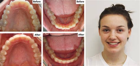 Invisalign Orthodontics Lee Dental Associates Midtown Toronto