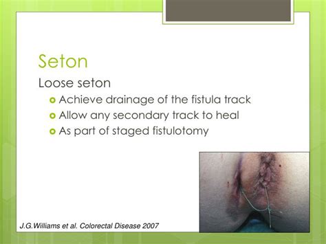 Ppt The Best Surgical Treatment For Fistula In Ano Powerpoint