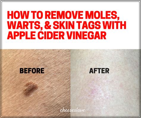 How To Remove Moles Using Apple Cider Vinegar Howtormeov