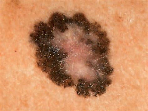 What Does Melanoma Skin Cancer Look Like Cancer News Update