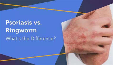 Psoriasis Vs Ringworm Whats The Difference Mypsoriasisteam