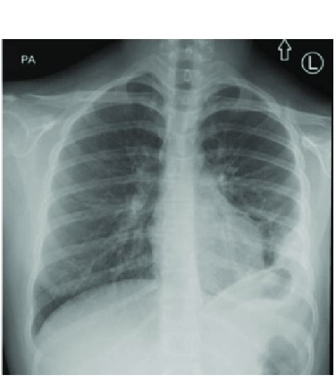 Frontal Chest Radiograph Obtained At Presentation Shows Left Lung Base