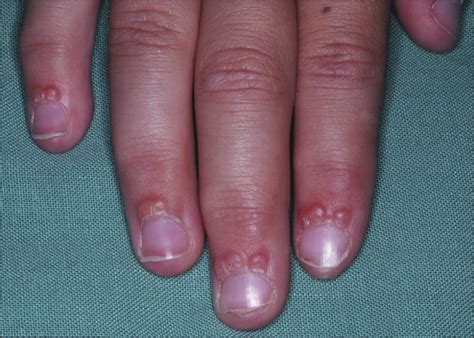 Asymptomatic Papules Over The Proximal Nail Fold In A Child—quiz Case