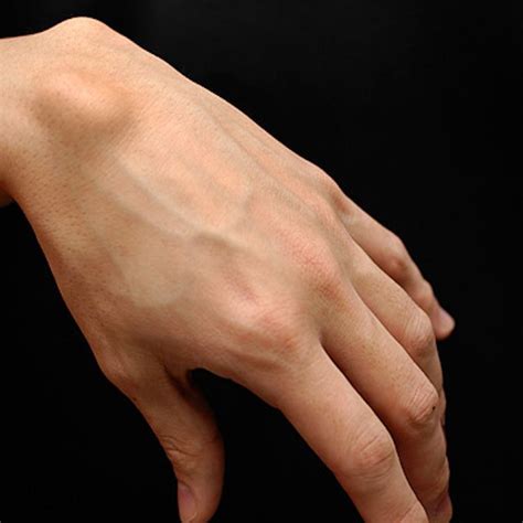 Wrist Ganglion Cyst Lump On The Back Of The Hand Images And Photos Finder