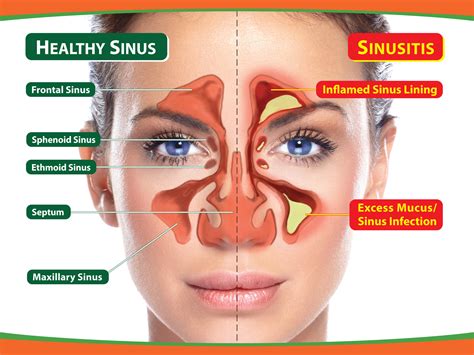 There is no one major cause, because it depends on each person. Ways to Relieve Sinus Pain, Aches and Congestion | Pamper.My