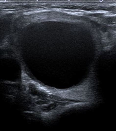 Delincuente Sitio Pekkadillo Colloid Cyst Ultrasound Heredero Accesible