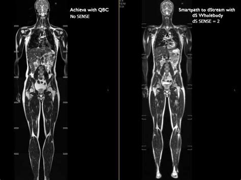 Total Body Imaging Philips Mr Body Map