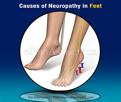 Causes Of Neuropathy In Feet And What Can Be Done For It
