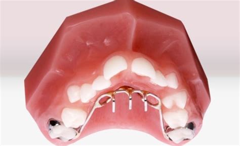 Orthodontic Appliances For Thumb Sucking Hayrake Dental Appliance