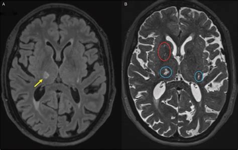 Clinical Management Of Cerebral Small Vessel Disease A Call