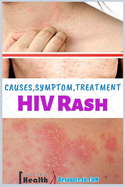 Hiv Rash Pictures Symptoms And Treatment Symptoms Causes Treatment