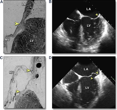Functional Implication Of Mitral Annular Disjunction In Mitral Valve