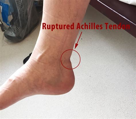 A strong piece of tissue in the body connecting a muscle to a bone 2. Acute Achilles Tendon Ruptures - OPA Ortho