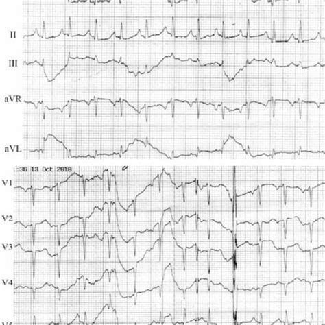 Signs Of Acute Anteroseptal Myocardial Infarction On Admission