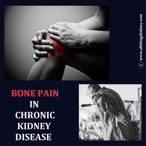 Bone Pain In Chronic Kidney Disease All Things Kidney Official
