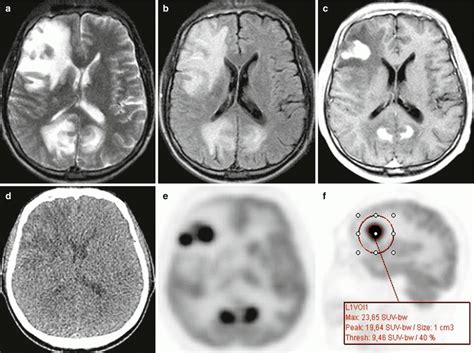 Cns Lymphoma Radiology Key