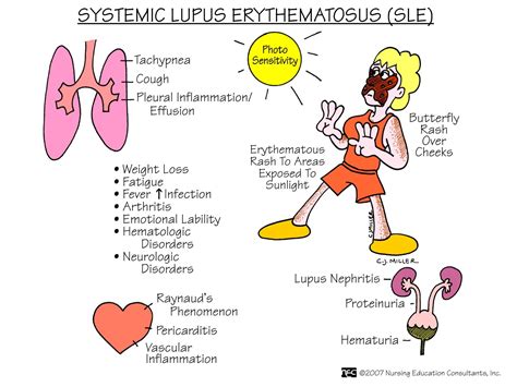 Systemic Lupus Erythmatosus Sle Nursing Mnemonics And Tips