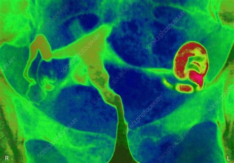 Extra Uterine Pregnancy X Ray Stock Image C0270959 Science