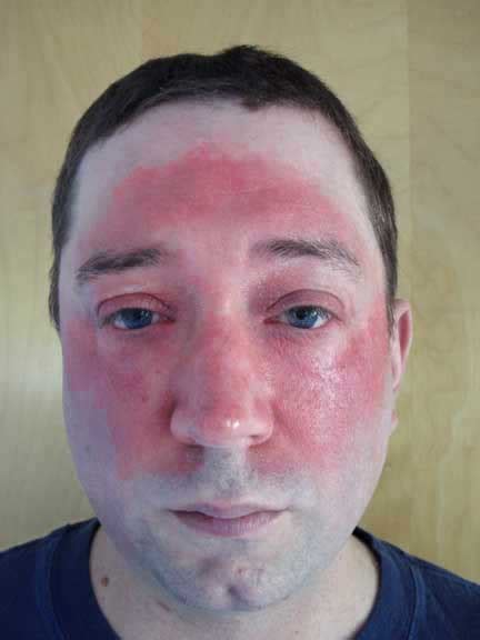 Virtual Grand Rounds In Dermatology 20 Facial Erythema Secondary To