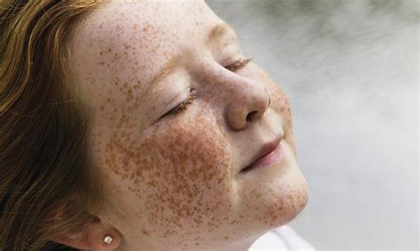 8 Things You Never Knew About Freckles