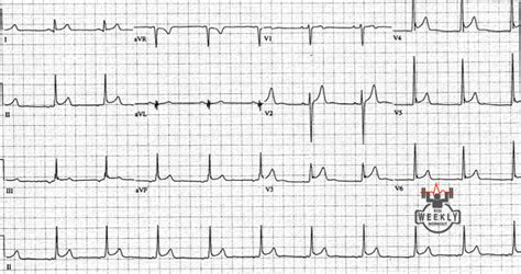 De wikipedia, la enciclopedia libre. Amal Mattu's ECG Case of the Week - October 24, 2016 - ECG ...