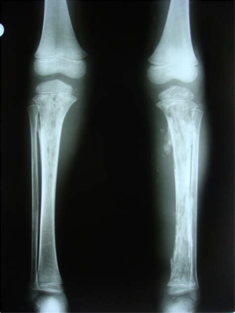 Bilateral Acute Tibial Osteomyelitis In A Patient Without An Underlying